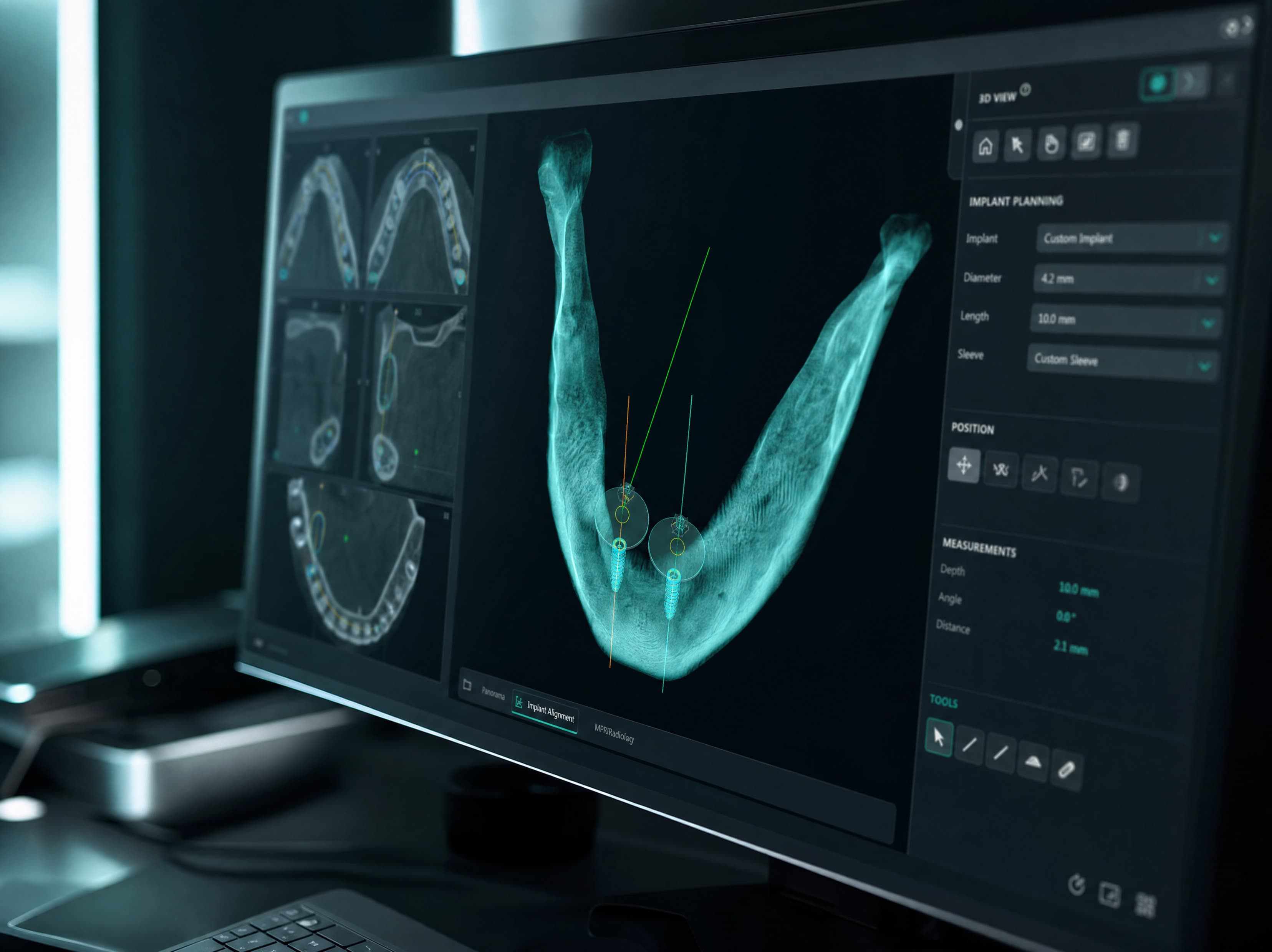 Implant Planning